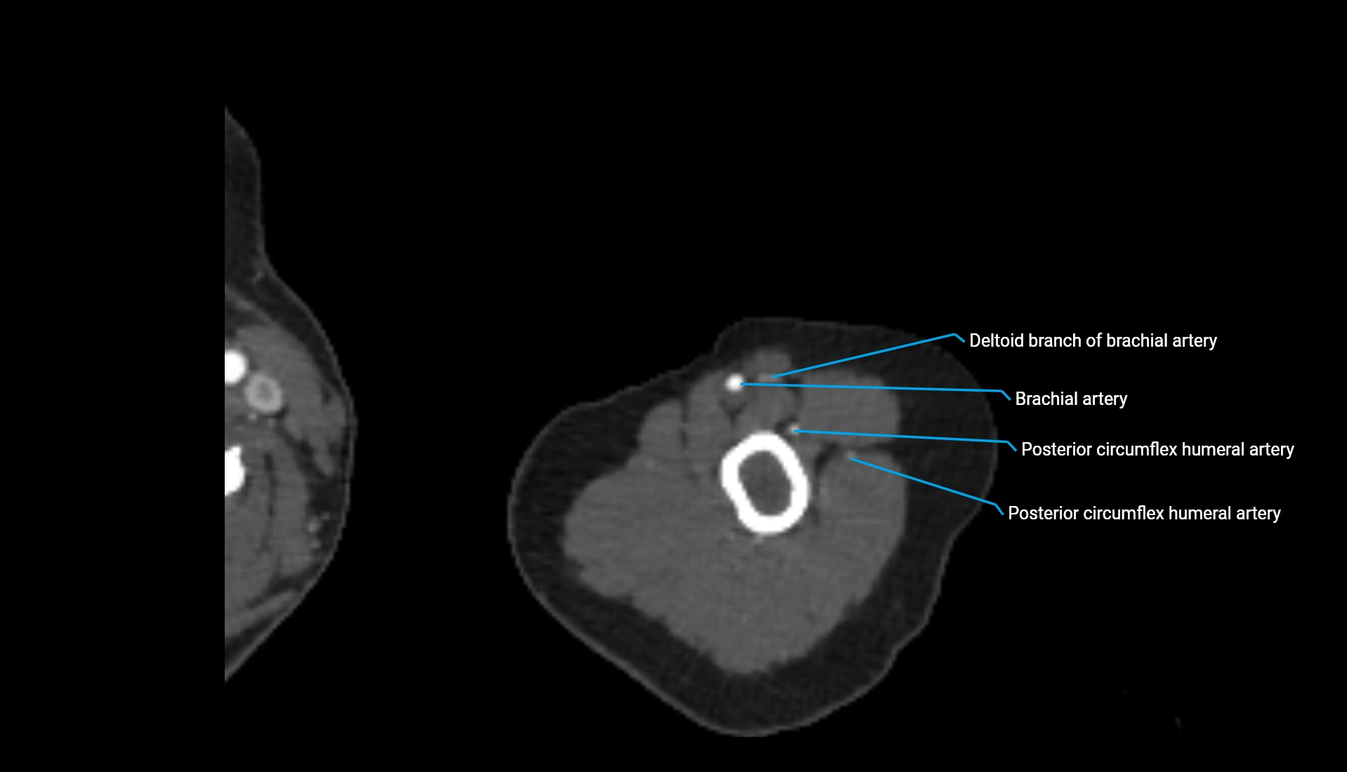 CTA upper limb axial cross sectional anatomy labelled image 304 (2).webp
